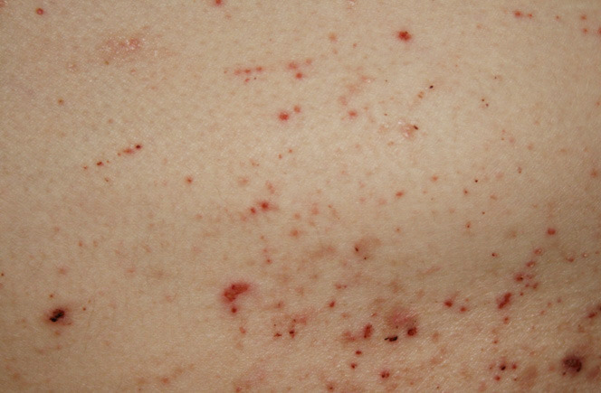 Huid met schurft, rode bultjes, vlekjes en puntjes