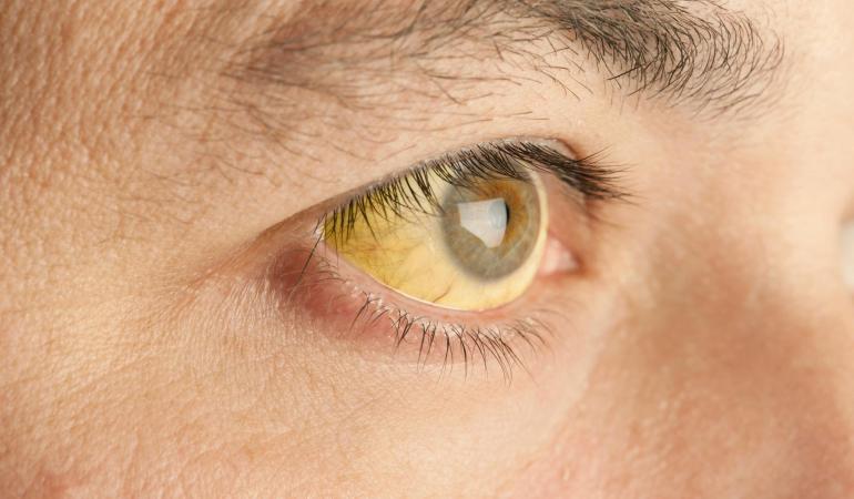 geel gekleurd oog door hepatitis