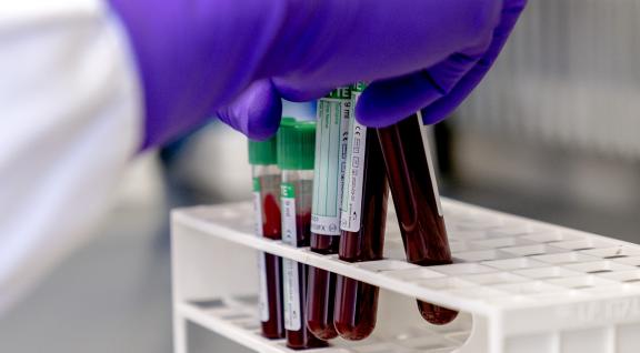 Verschillende commerciële laboratoria gebruiken zogeheten cellulaire testen voor Lyme. Helaas zijn niet betrouwbaar.