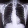 Röntgenfoto van de longen.