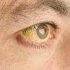 geel gekleurd oog door hepatitis